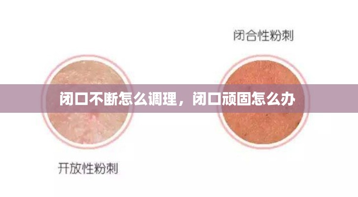 闭口不断怎么调理,闭口顽固怎么办
